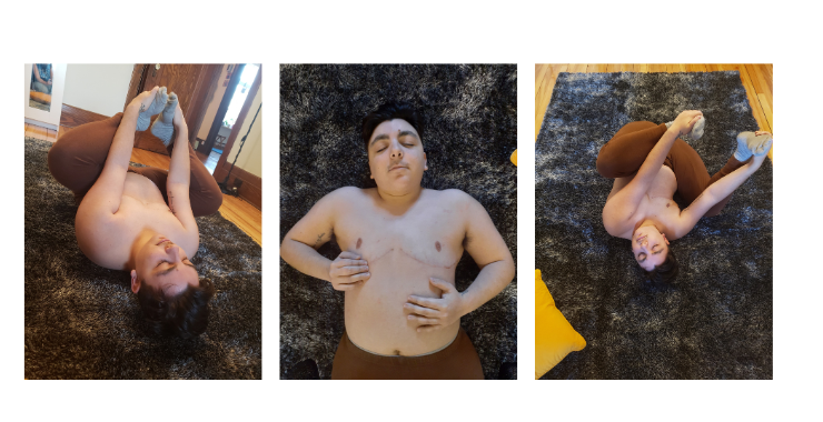 Surgical PTSD trauma trans top surgery